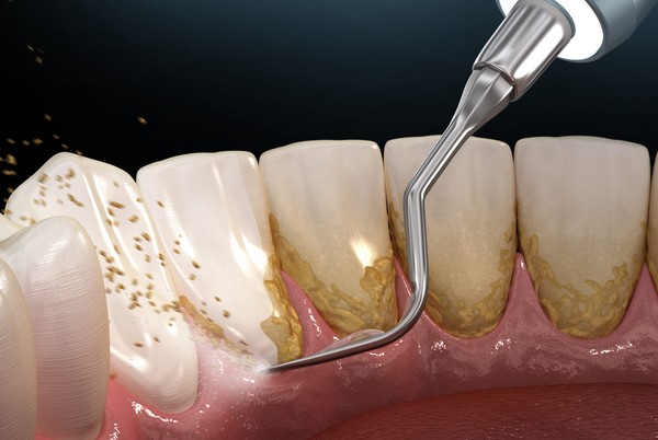 dental-plaque